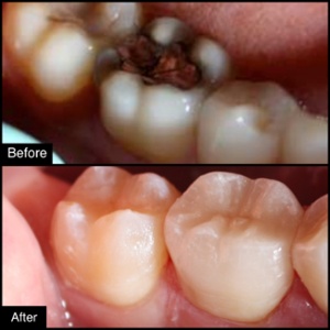 Fillings, Dental Inlays, and Onlays - Dr. Anderson