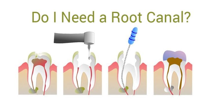 Root Canal Treatment: 5 Common Myths Debunked