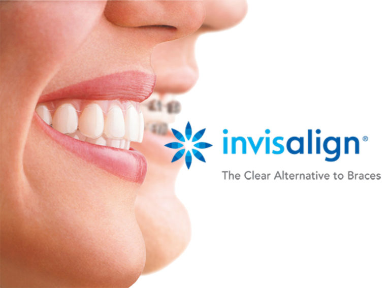 invisible braces company