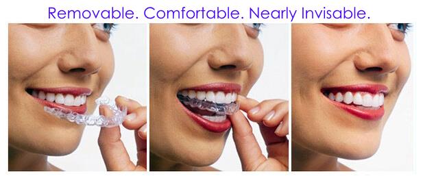 QUESTION: Do Invisalign Removable Braces Really Work?