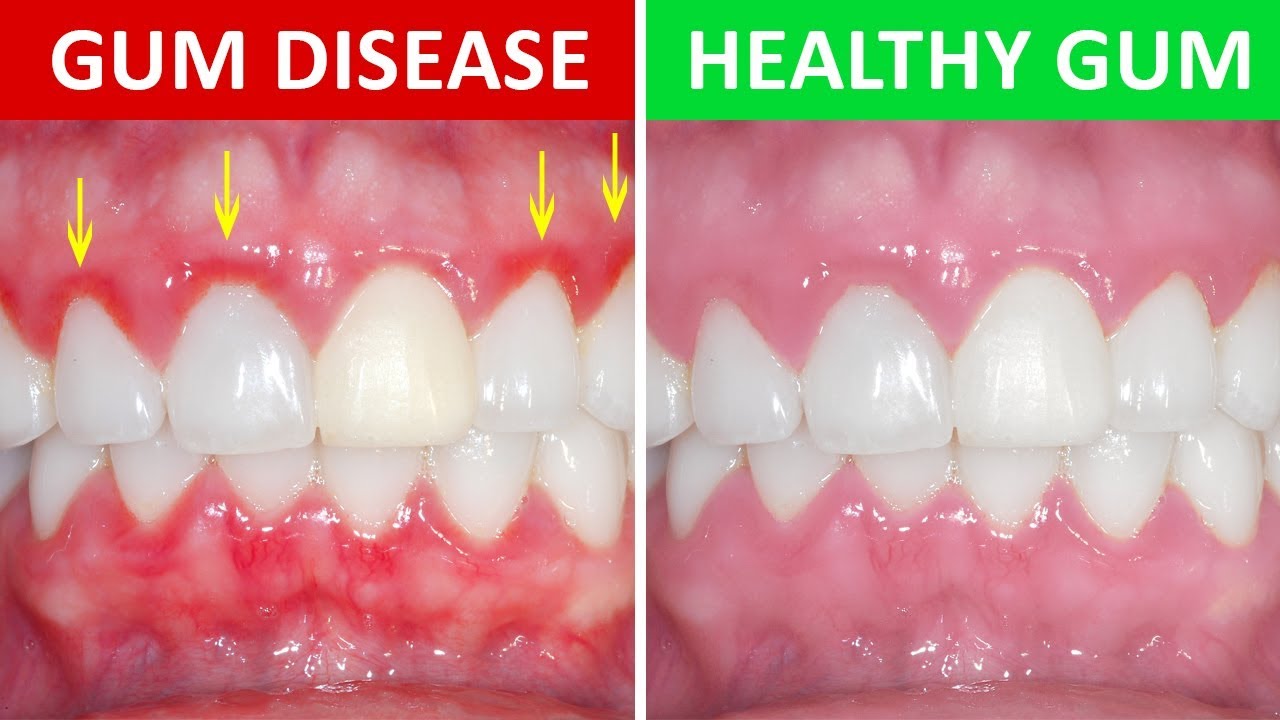 gum disease - Just How To Remove Cavities: Natural Remedy And Prevention