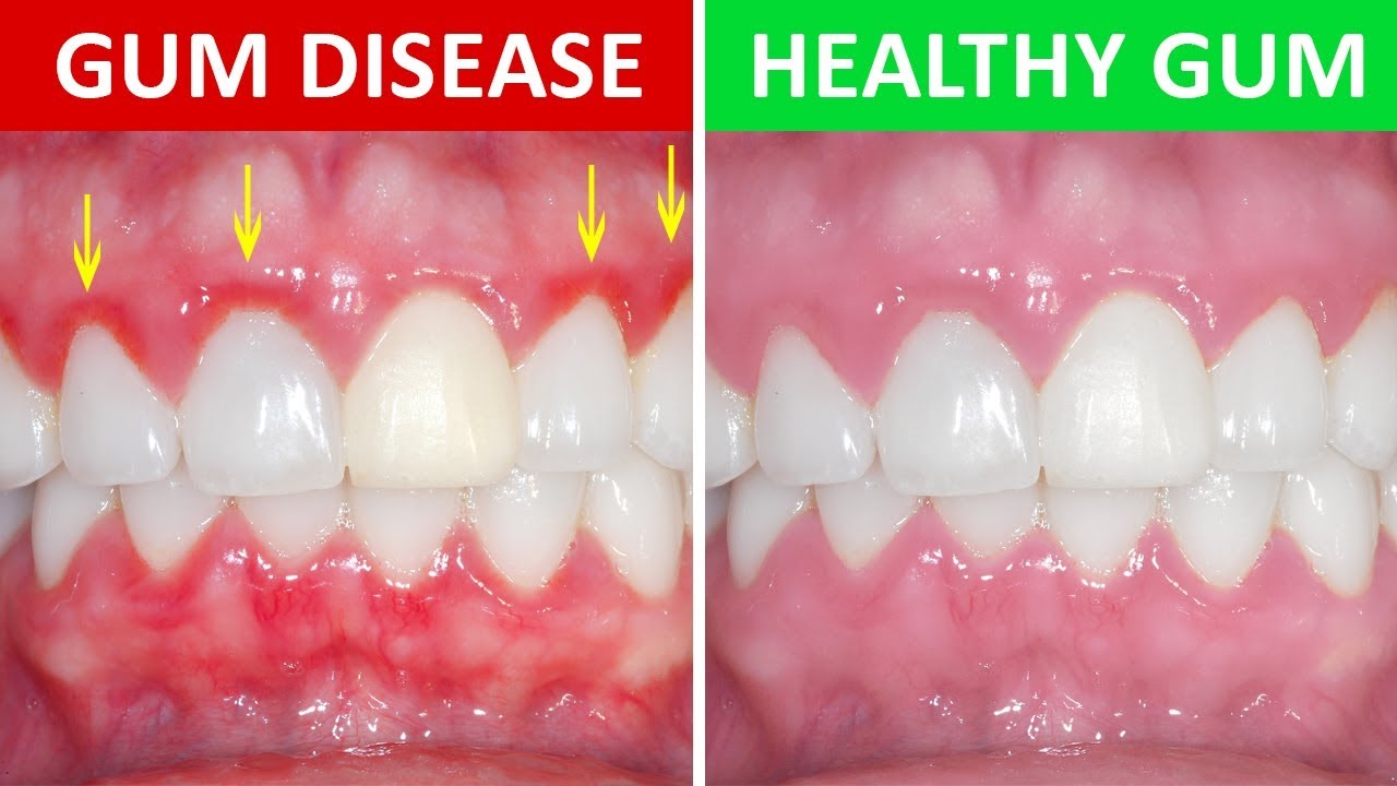 How Long Can You Keep Your Teeth With Periodontal Disease?