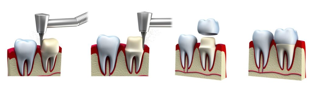 How a General Dentist Uses Crowns to Repair Teeth