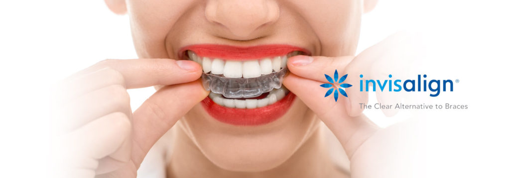 Why Should I Straighten my Smile with Invisalign Invisible Braces?
