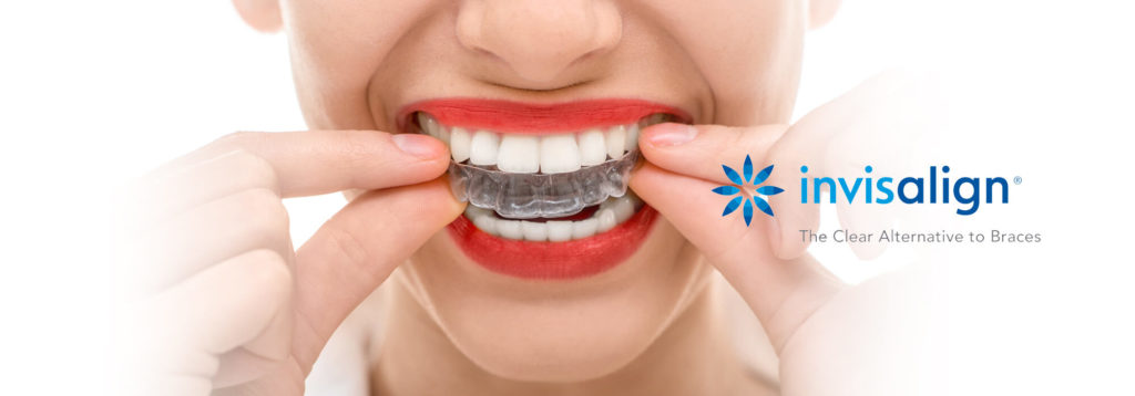 Invisalign: An Effective Alternative to Metal Braces