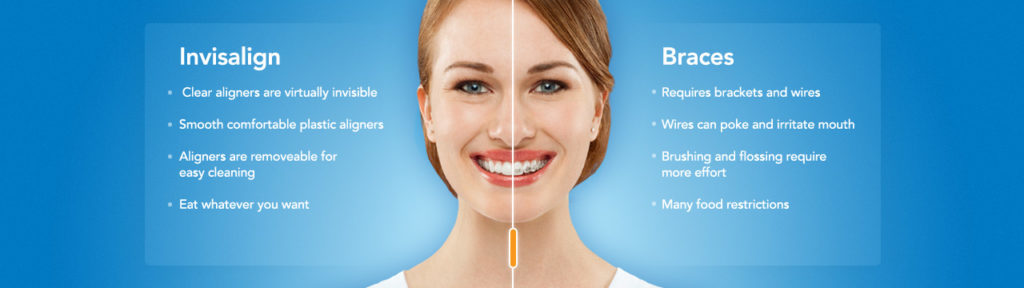 Invisalign Vs. Braces: Cost, Effectiveness, and Appearance