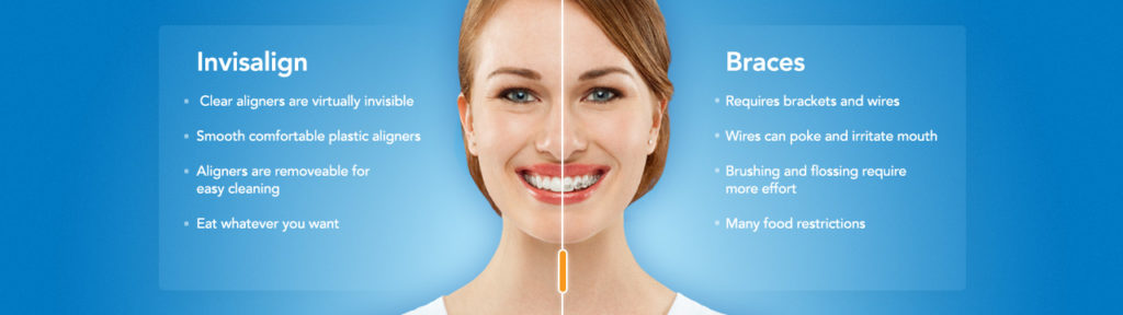 Invisalign Braces: The Facts You Want to Know - Family & Cosmetic