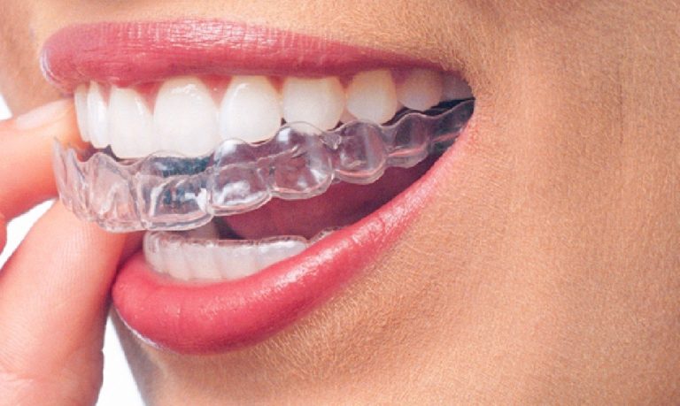 invisible aligners or braces