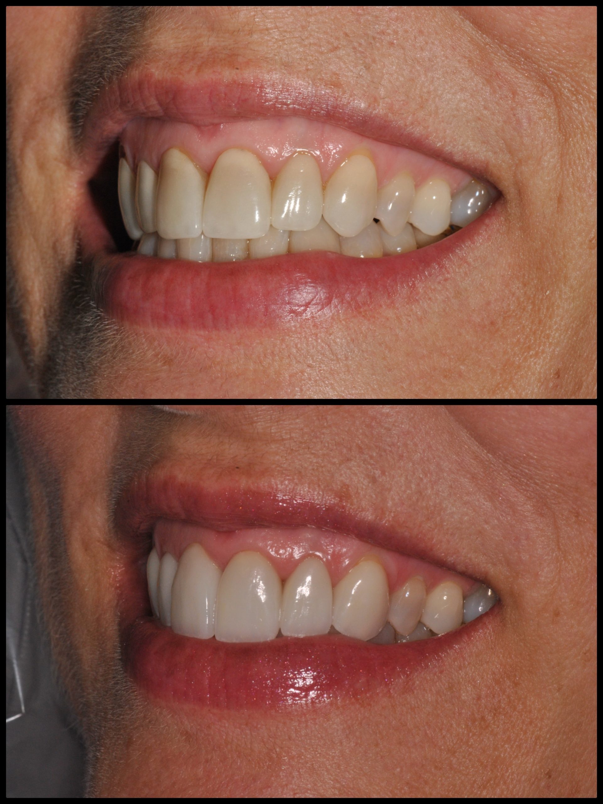 tetracycline spotlight veneers