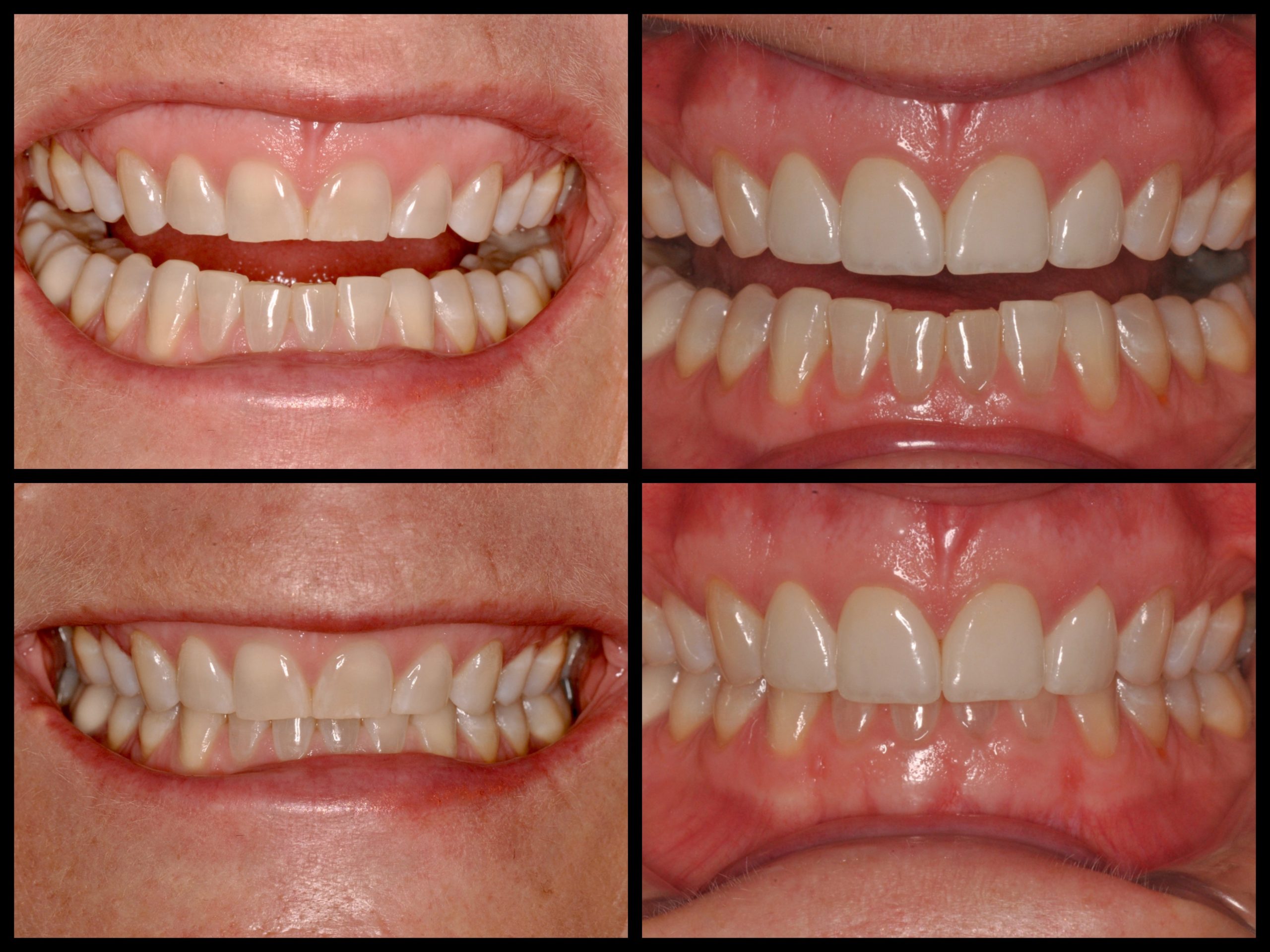 bulky veneers