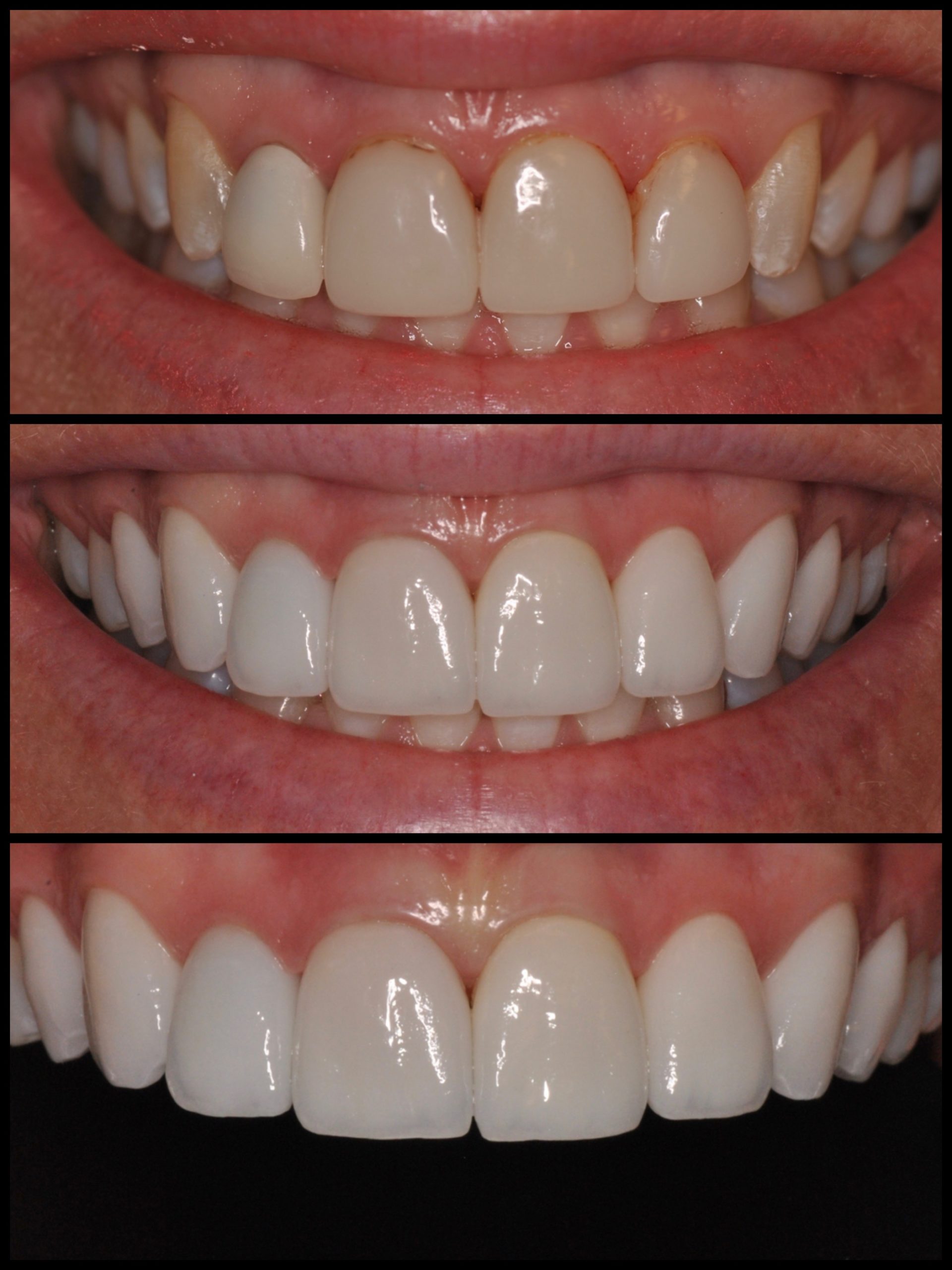 Invisalign Pros and Cons of Invisible Braces - Thomas L. Anderson DDS