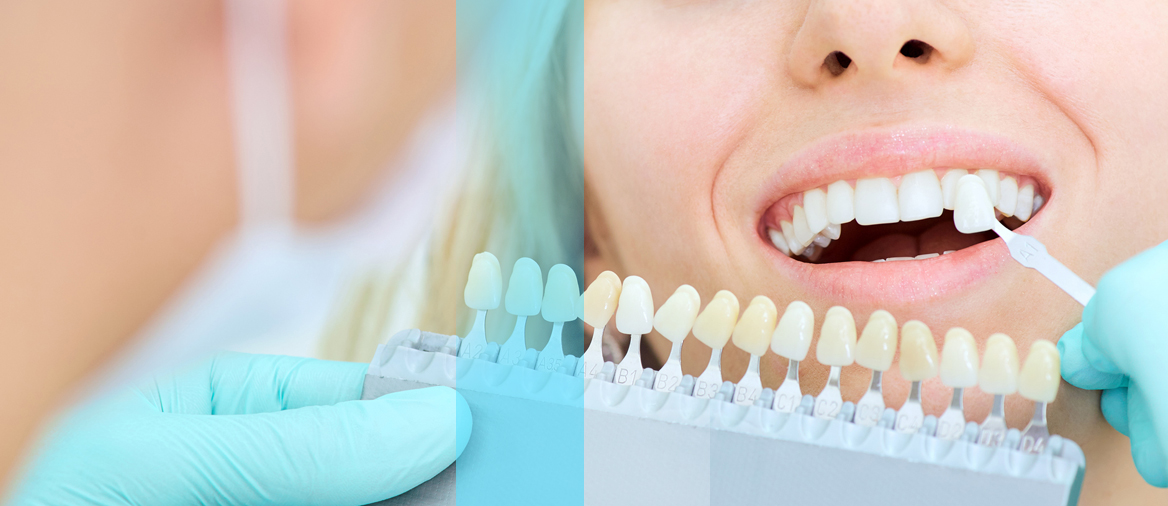 Are You Ready For A Porcelain Veneer Smile Upgrade In 2021?