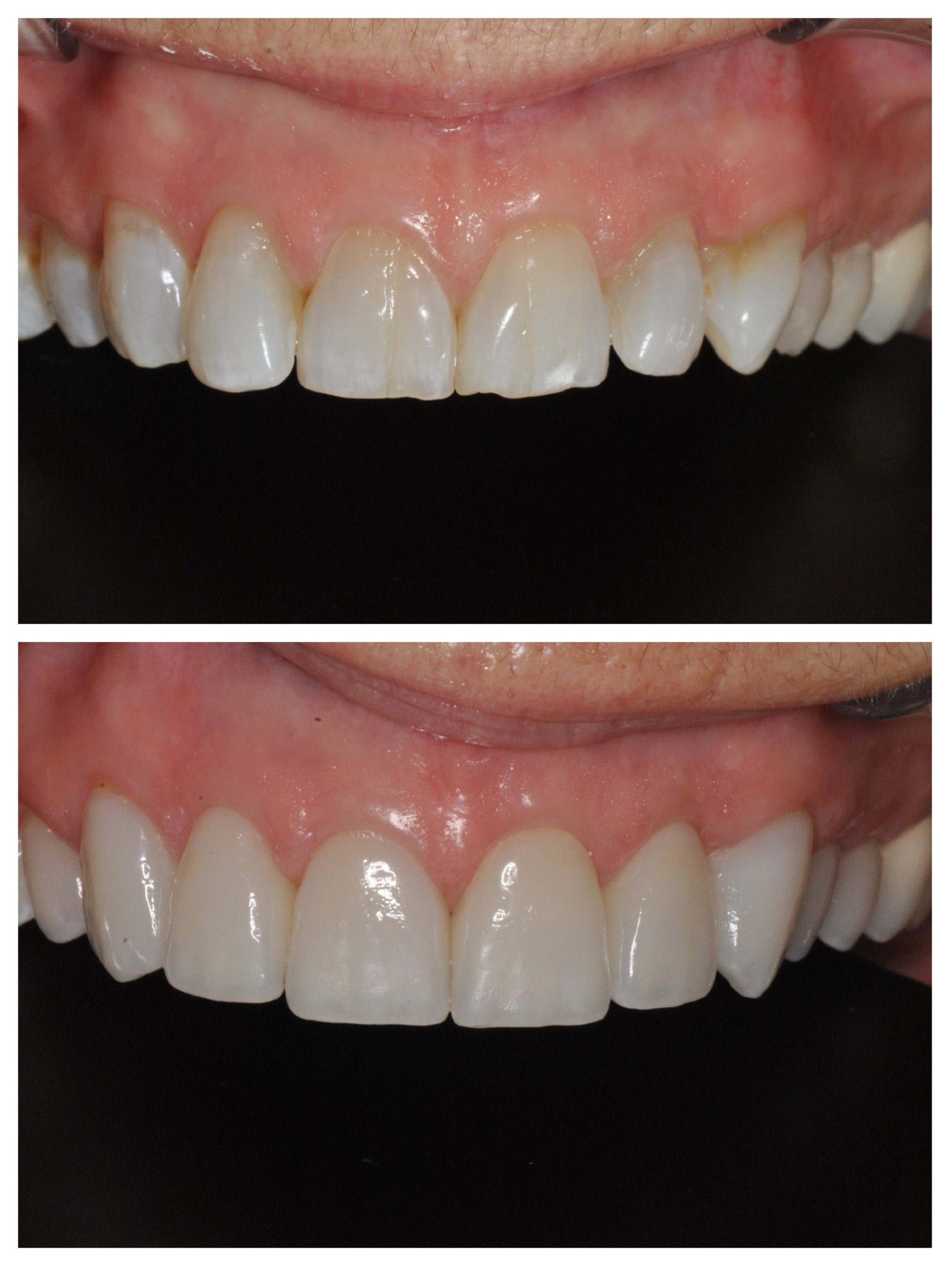 molar crown before after