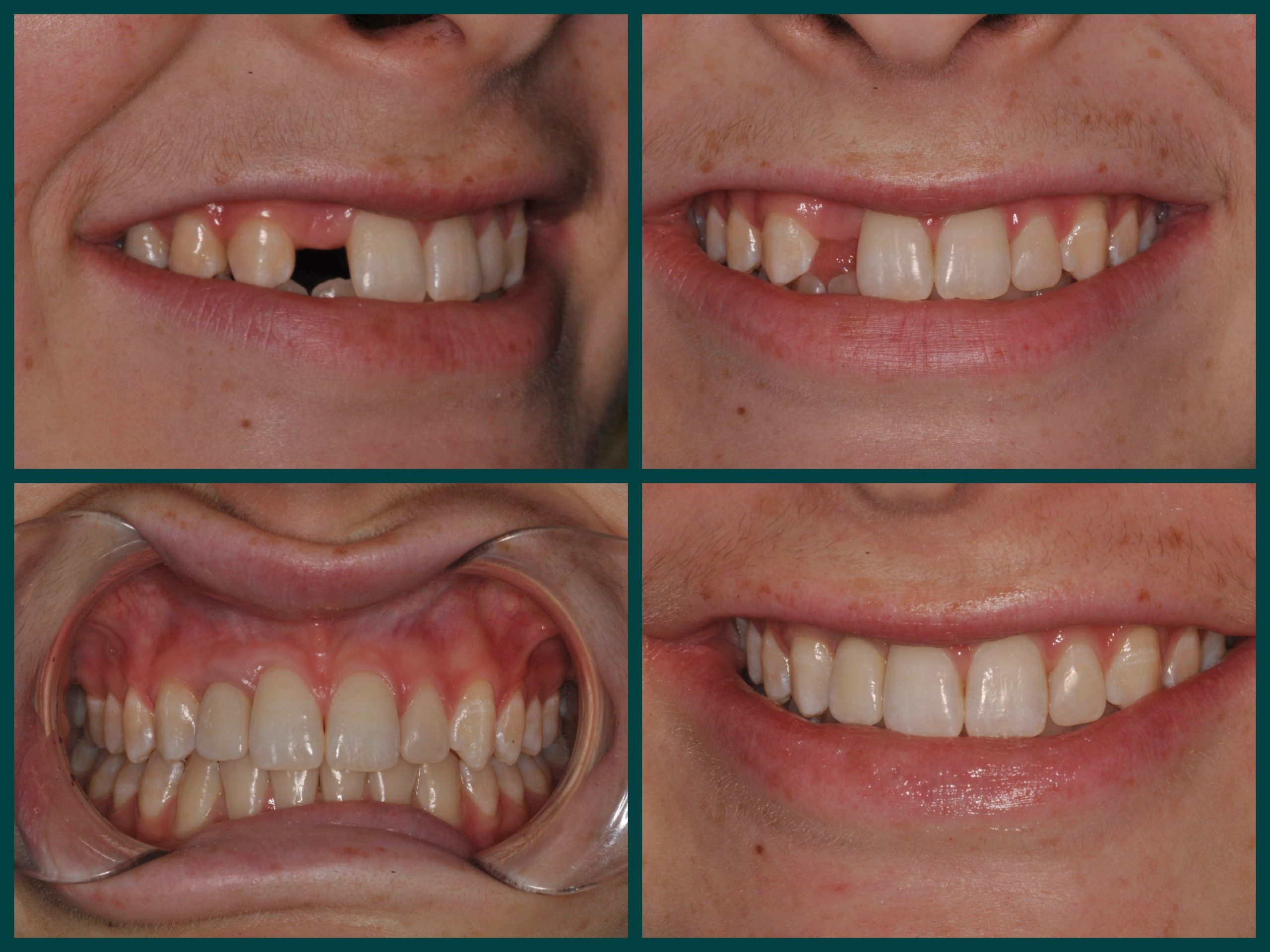 Tooth Implant Before And After