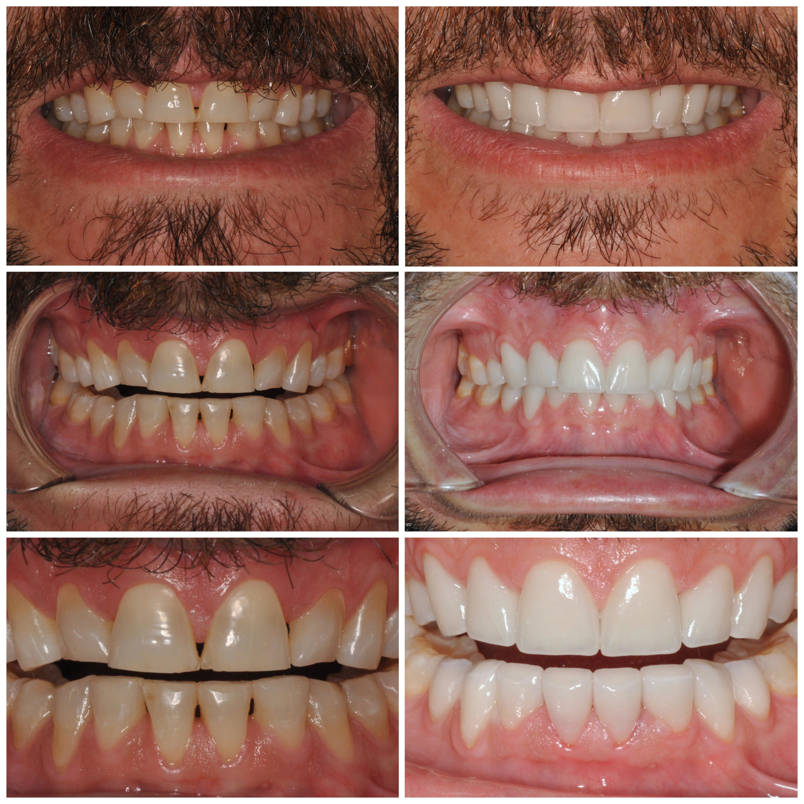 Illustration Of Cracked Tooth Repair Smile Mouth With Cracked