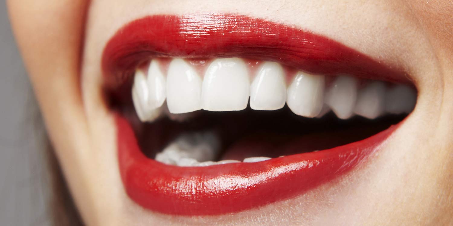 5 Things You Need To Know Before Getting Porcelain Veneers