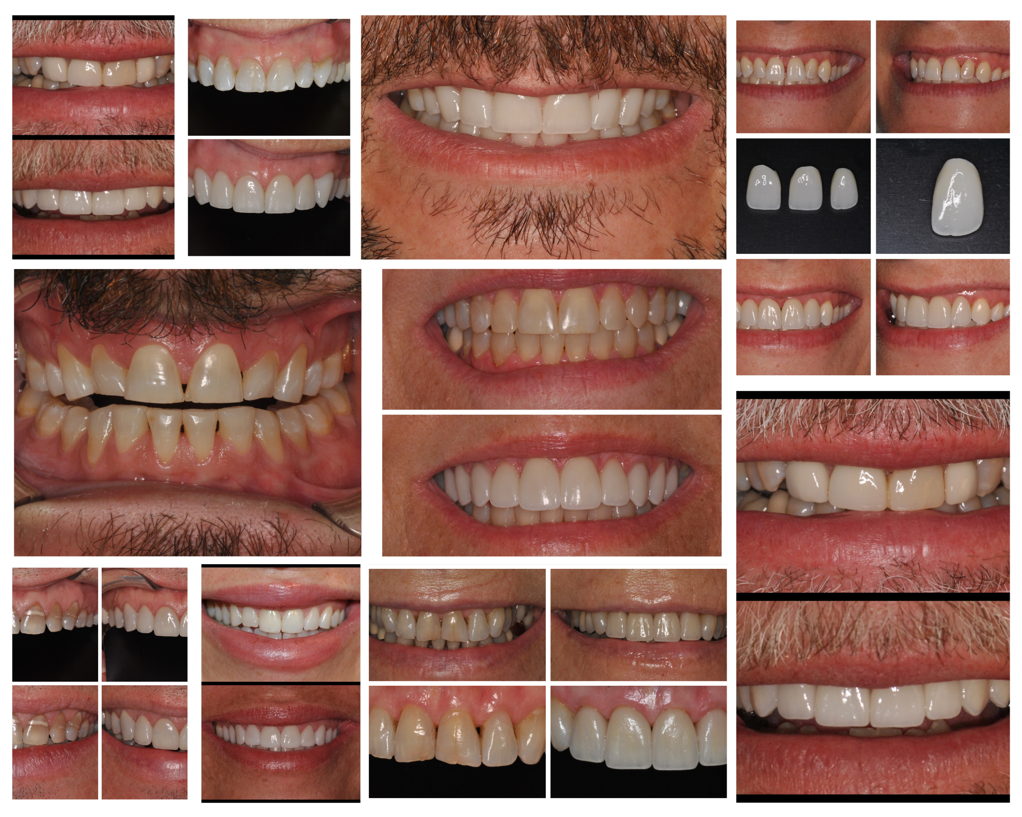 Incredible Smile Makeover With Gum Contouring & Veneers