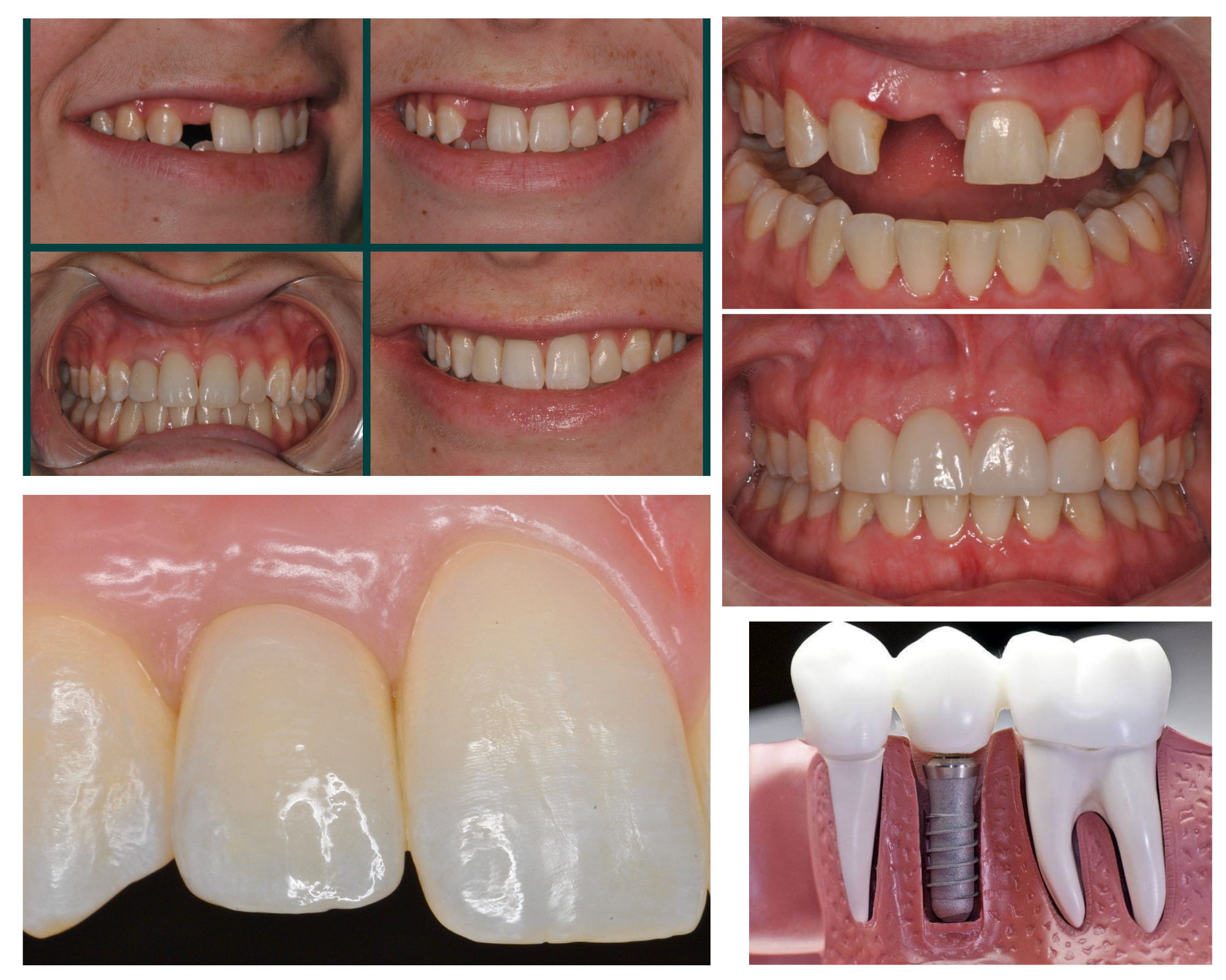 Tooth Replacement Smile Makeover: Ready to Enhance Your Smile?