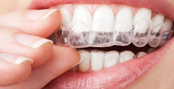 Invisalign Pros and Cons of Invisible Braces - Thomas L. Anderson DDS