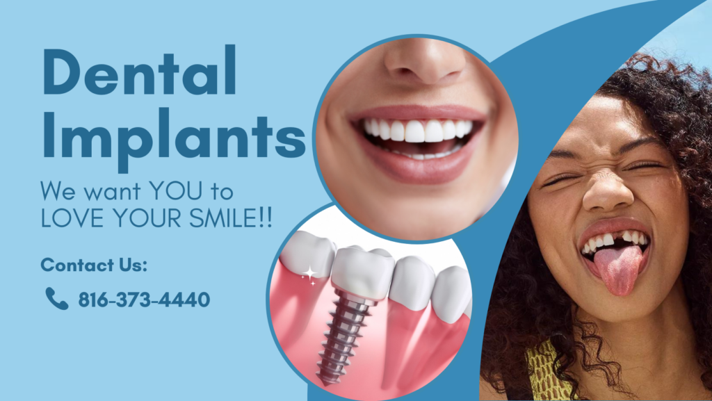 Dental-Implants-Kansas-City