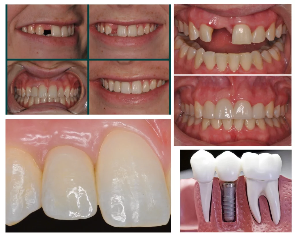 tooth-replacement-smile-makeover